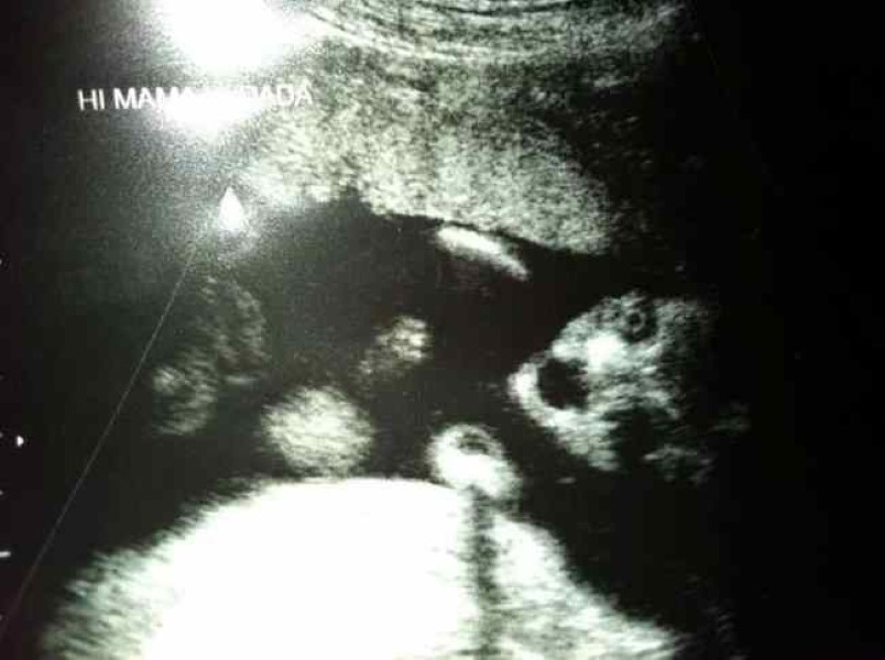 Baby Scans