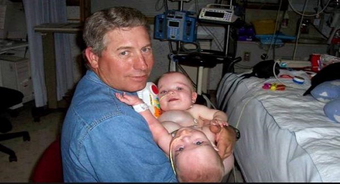 conjoined triplets 3